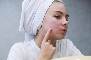 Say Goodbye to Blemishes: The Ultimate Guide to Acne Spot Removal Creams